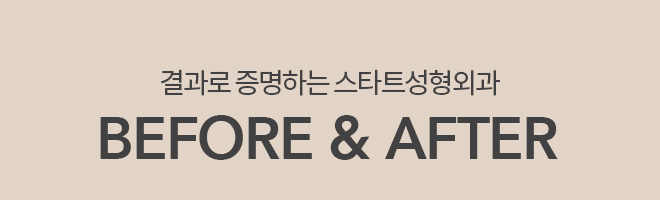 결과로 증명하는 스타트성형외과 BEFORE & AFTER