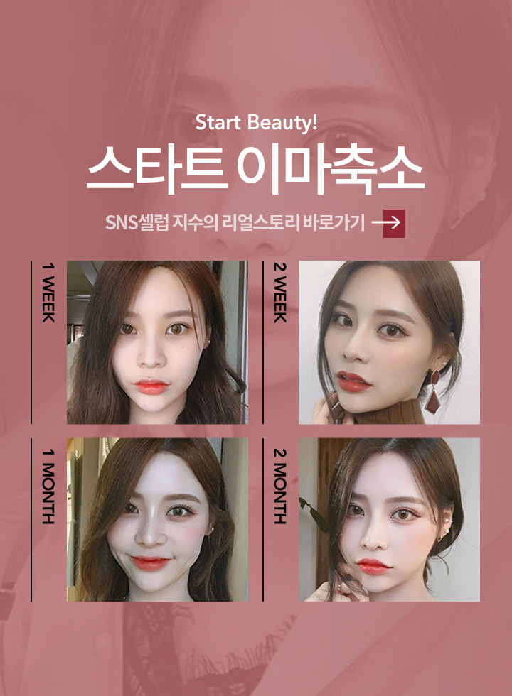 스타트 이마축소